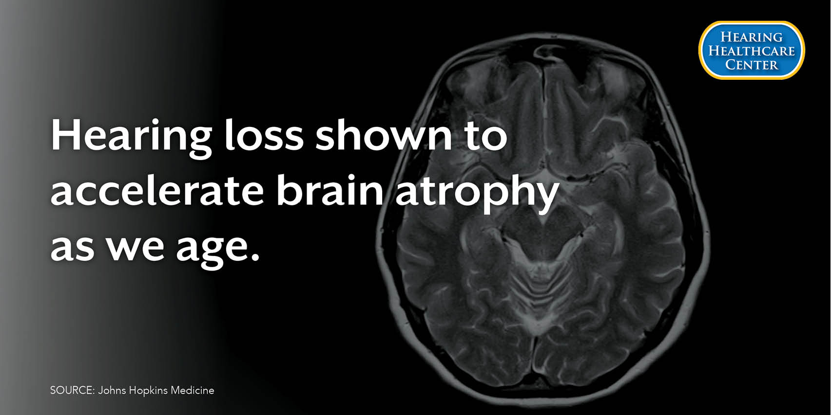 How Untreated Hearing Loss Accelerates Brain Shrinkage: Key Findings from Recent Study